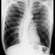 Chest X-ray - Copd And Scoliosis Poster