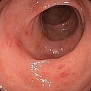 Inflamed Colon From Viral Gastroenteritis Poster