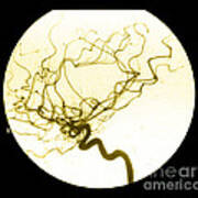 Internal Carotid Cerebral Angiogram Poster