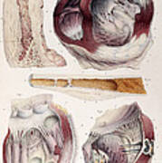 Heart, Aneurysm, Illustration, 1838 Poster