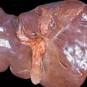 Unhealthy Human Liver #2 Poster