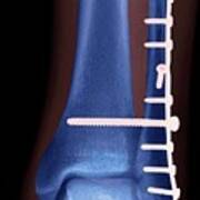 Ankle Fracture Poster