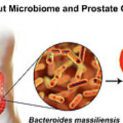 Gut Microbiome And Prostate Cancer Poster