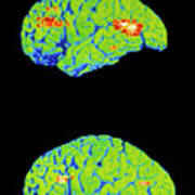 Pet Scan Of Depressed And Normal Brain Poster