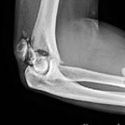 Broken Elbow, X-ray #1 Art Print