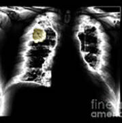 Lung Cancer, X-ray #1 Art Print