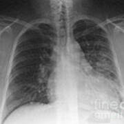 Pneumonia, X Ray #1 Art Print