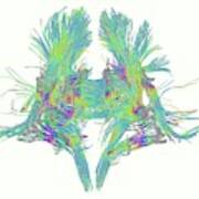 White Matter Fibres Of The Human Brain Art Print