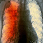 Lung Cancer X-ray #2 Art Print