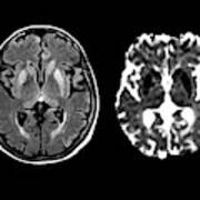Brain In Creutzfeldt-jakob Disease #3 Art Print