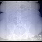 X-ray Of Morbidly Obese Patient #3 Art Print