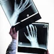 X-rays Of Hands #5 Art Print