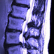 Arthritic Spine Art Print