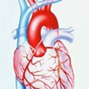 Artwork Showing Atherosclerosis Of Coronary Artery Art Print