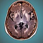Brain In Creutzfeldt-jakob Disease Art Print