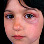 What Causes A Black Eye? - Potthoff Eye Care and Surgery