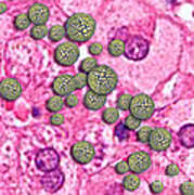 Hepatitis A Infecting Liver Tissue Art Print