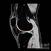 Knee Hyaline Articular Cartilage Art Print