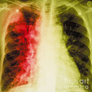 Lung Cancer X-ray Art Print