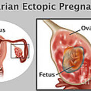 Ovarian Pregnancy Art Print