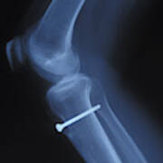 X-ray Of Knee With Screw Art Print