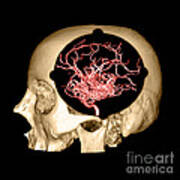 3d Image Of Skull And Brain Avm #1 Art Print