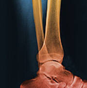 Foot X-ray #1 Art Print