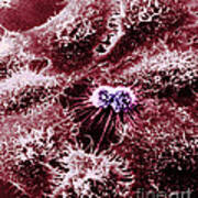 Hela Cells With Adenovirus #2 Art Print