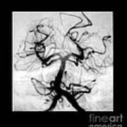 Angiogram Of Embolus In Cerebral Artery #3 Art Print
