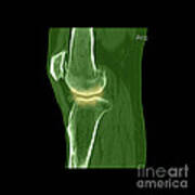 Knee Showing Osteoporosis #3 Art Print