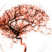 Cerebral Angiogram Art Print