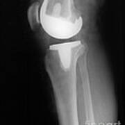 Knee Replacement X-ray #5 Art Print
