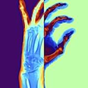 Arthritic Hand, X-ray #6 Art Print