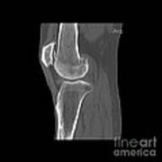 Knee Showing Osteoporosis #7 Art Print