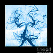 Angiogram Of Embolus In Cerebral Artery Art Print