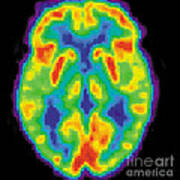 Pet Scan Of 80-year-old Brain, 2 Of 2 Art Print