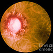 Retina Infected By Syphilis Art Print