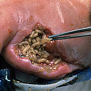 Surgeon Placing Maggots In A Wound To Clean It Photograph by Volker Steger  - Pixels