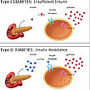 Diabetes I & Ii #2 Art Print