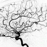Dural Arterial Venous Fistula, Angiogram Art Print