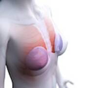 Breast Implants #18 by Sebastian Kaulitzki/science Photo Library