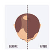 Man Before And After Hair Transplant Art Print