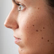 Portrait Of A Woman With Melanoma Moles And Freckles (xxxl) #1 Art Print