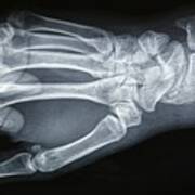 Close Up Of A Hand And Wrist X-ray Film Art Print
