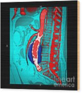 Abdominal Stent Graft #1 Wood Print