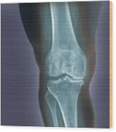 Arthritis Of The Knee #1 Wood Print
