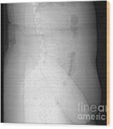 X-ray Of Morbidly Obese Patient #1 Wood Print