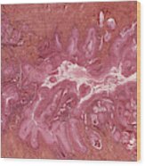Cervical Cancer Wood Print