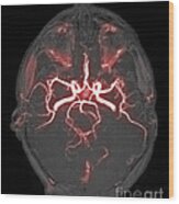 Circle Of Willis, Angiogram Wood Print