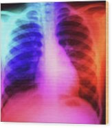 False-colour Chest X-ray: Normal 7 Year-old Child Wood Print